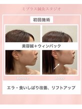 ミプラス鍼灸スタジオ/ビフォーアフター