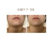 ムク(MUKU 無垢)/結果で選ばれる小顔ケア