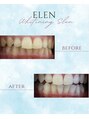 エレン 高槻店(ELEN)&nbsp;セルフホワイトニング/大阪/高槻/茨木/小顔/美白