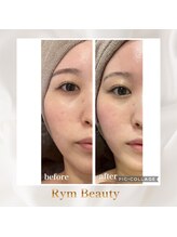 リム ビューティー(RYM BEAUTY)/サーマ＋最新小顔超音波