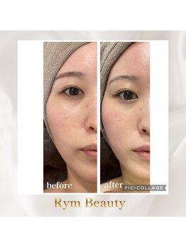 リム ビューティー(RYM BEAUTY)/サーマ＋最新小顔超音波