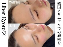 エステティック リベル キョウト 京都駅前店(Esthetic Liber Kyoto)/エステ版ポテンツァ水光肌注入