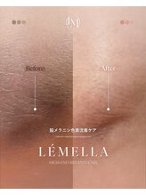 エルビービュティーサロン(LB BEAUTY SALON)/【ルメラ乳輪】実績数関西1★