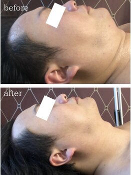 メイクアップス(makeups)/男性リフトアップフェイシャル