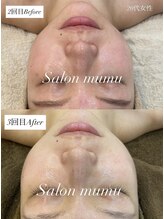 ムム(mumu)/ハーブピーリング/REVI