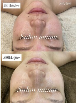 ムム(mumu)/ハーブピーリング/REVI