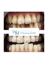 ホワイトニング モア(Whitening MORE)/ビフォーアフター