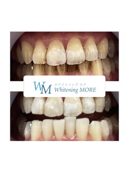 ホワイトニング モア(Whitening MORE)/ビフォーアフター