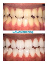 ララホワイトニング/Before&After強力ホワイトニング