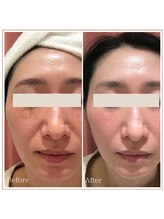 ベルタ 仙台店(BELTA)/【ケア前→後】