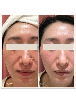 ベルタ 仙台店(BELTA)/【ケア前→後】