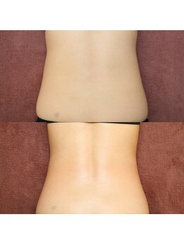 カブール三宮/1回の施術のBefore→After★