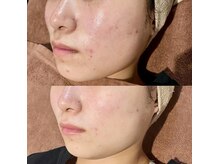 カルナ(CARNA)/トラブル前に肌を巻き戻す