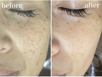 ホワイトアクア 京橋店(WHITE AQUA)/ララピール3回でシミ改善