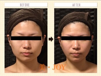 美 ジョイ(美 JOY)/小顔コルギ　施術例