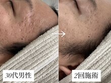 リベルテ(LIBERTE)/30代肌の凹凸ケア