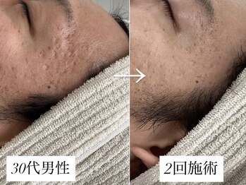 リベルテ(LIBERTE)/30代肌の凹凸ケア