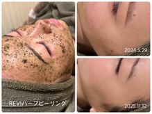 アイラッシュアンドビューティースタジオ ビット(bit)の雰囲気(【初回】幹細胞ハーブピーリング+美容成分1/2☆11,000円)