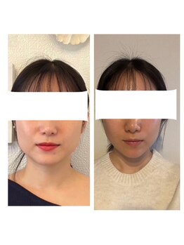 サロン ド ルポゼ(Salon de Reposer)/頭蓋骨調整＋サーマ小顔