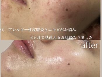 ブルーム(BLOOM)/WISHproビフォーアフター　5回