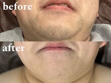 ボス 津店(BOSS)/【メンズ脱毛/ヒゲ脱毛】