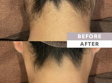 カウイ(KAUI)/うなじ脱毛