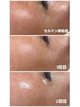 エムイーボーテ(me.Beaute)/【セルマン】目尻のシワ改善！