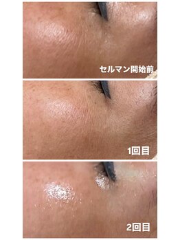 エムイーボーテ(me.Beaute)/【セルマン】目尻のシワ改善！