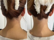 シロ(Shiro)/うなじのデザイン脱毛