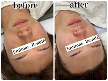 エミマス ボーテ(Emimas Beaute’)/メンズも毛穴洗浄でツルスベお肌