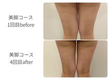 ほねつぎ一休さん 宇品店/すっきり美脚コース