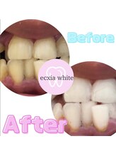 エクシアホワイトニング 前橋店/ビフォーアフター