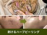 【徹底肌質改善】剥離ハーブピーリング!ヒト幹細胞入り★ダウンタイム1週間