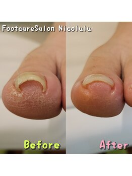 巻き爪補正ビフォーアフター