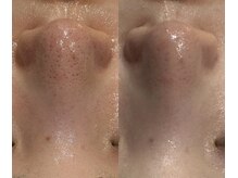 アルメ(arme)/【毛穴】