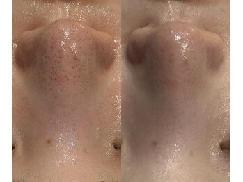 アルメ(arme)/【毛穴】