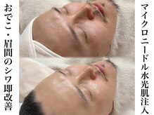 エステティック リベル キョウト 京都駅前店(Esthetic Liber Kyoto)/エステ版ポテンツァ水光肌注入