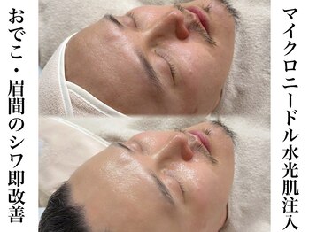 エステティック リベル キョウト 京都駅前店(Esthetic Liber Kyoto)/エステ版ポテンツァ水光肌注入
