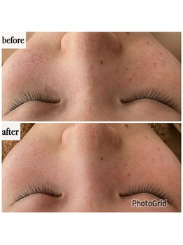 メナードフェイシャルサロン 岐阜茜部/炭酸パック