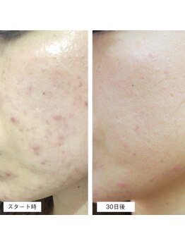 スパチャーレ(Spa ciare)/肌ファス