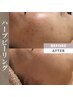 【くすみ・毛穴・ニキビでお悩みの方へ】韓国美肌SFハーブピーリング 