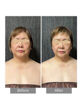 ヒヨリ(hiyori)/《before/after》フェイシャル