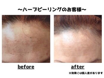 トータルビューティーみつとも/ハーブピーリング