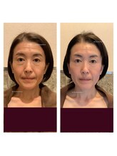 アクア エステティコ 亀有(ACQUA estetico)/フェイシャル1年経過　