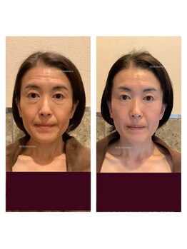 アクア エステティコ 亀有(ACQUA estetico)/フェイシャル1年経過　