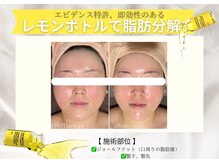 エステティックサロン フェアリー(ESTHETIC SALON FAIRLY)/小顔＊レモンボトル導入店