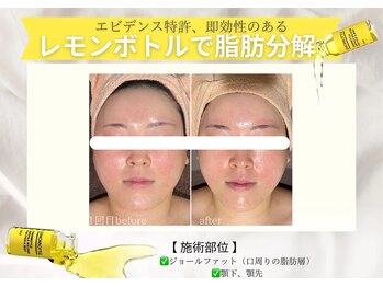 エステティックサロン フェアリー(ESTHETIC SALON FAIRLY)/小顔＊レモンボトル導入店