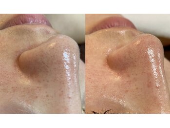 トータルエステサロン エステアンドメイク 錦糸町/光ケア×ハイドロピーリング