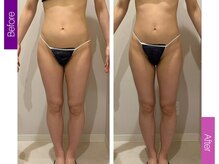 クレヴィア バイ サイバーエステ(CREBIA)/【太もも～お腹集中】90分