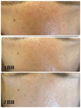 リム ビューティー(RYM BEAUTY)/ダクトピールで毛穴ケア